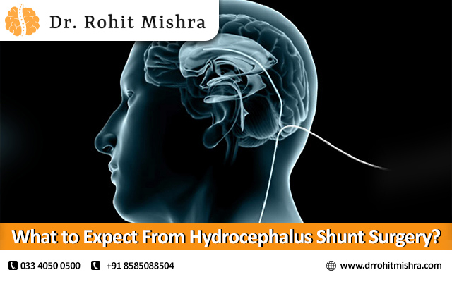 What to Expect From Hydrocephalus Shunt Surgery?