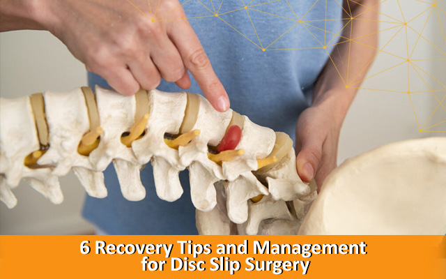 6 Recovery Tips and Management for Disc Slip Surgery