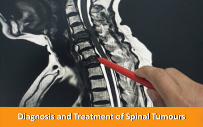 Diagnosis and Treatment of Spinal Tumours