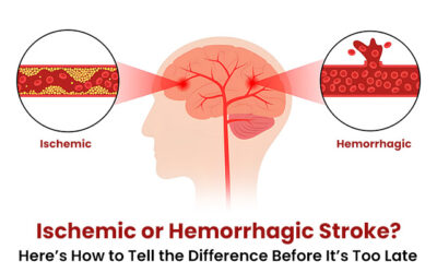 Ischemic or Hemorrhagic Stroke? Here’s How to Tell the Difference Before It’s Too Late