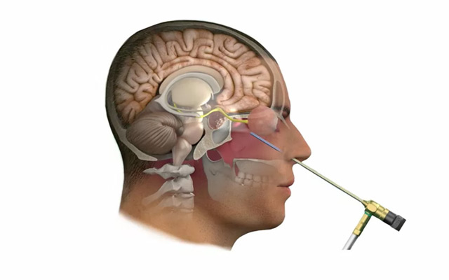 Skull Base Tumour Surgery